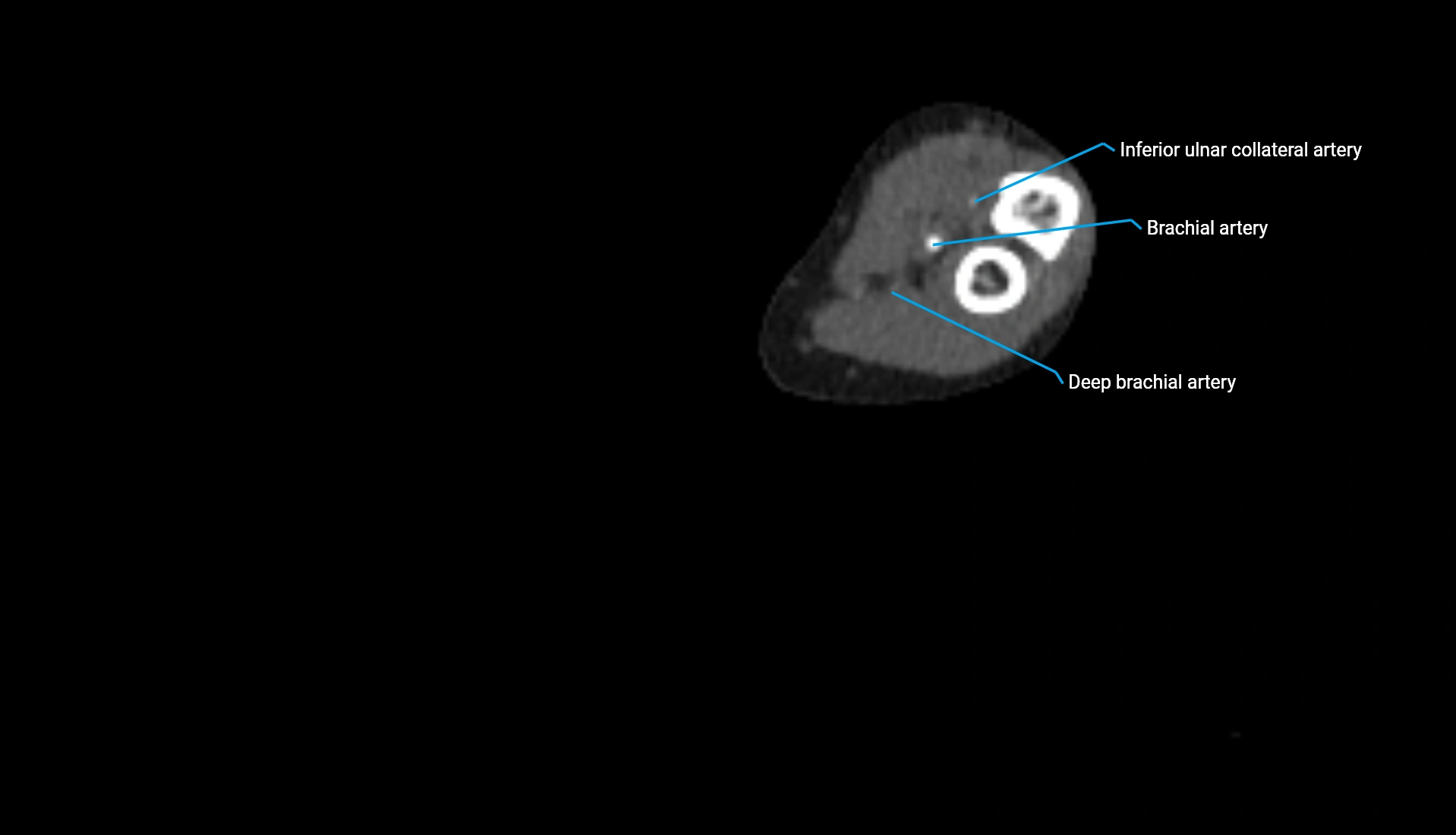 CTA upper limb axial cross sectional anatomy labelled image 174 (2).webp